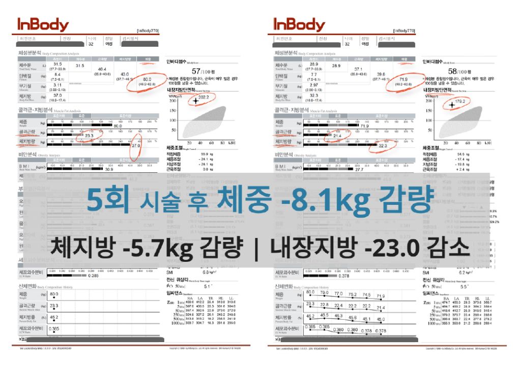 인바디 검사지: 5회 시술 후 체중 -8.1kg, 체지방 -5.7kg 감량, 내장지방 -23.0 감소 결과